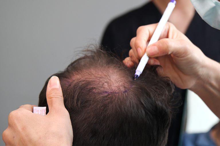 DHI Hair Transplant 2