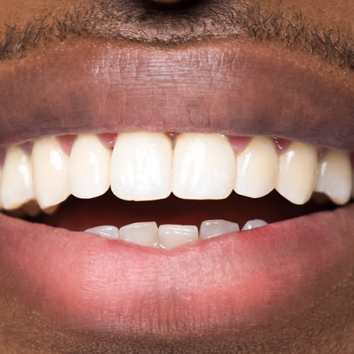 Full Mouth Restoration With Dental Implants