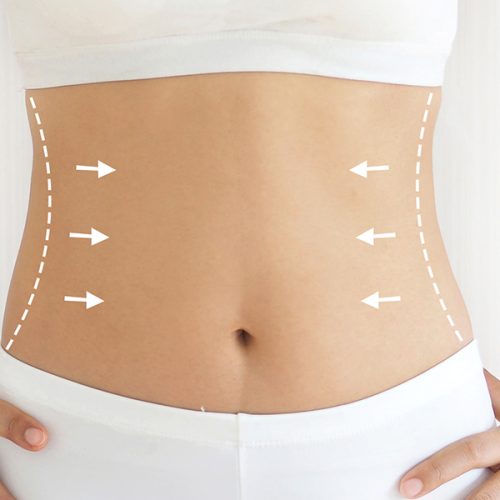 extended tummy tuck