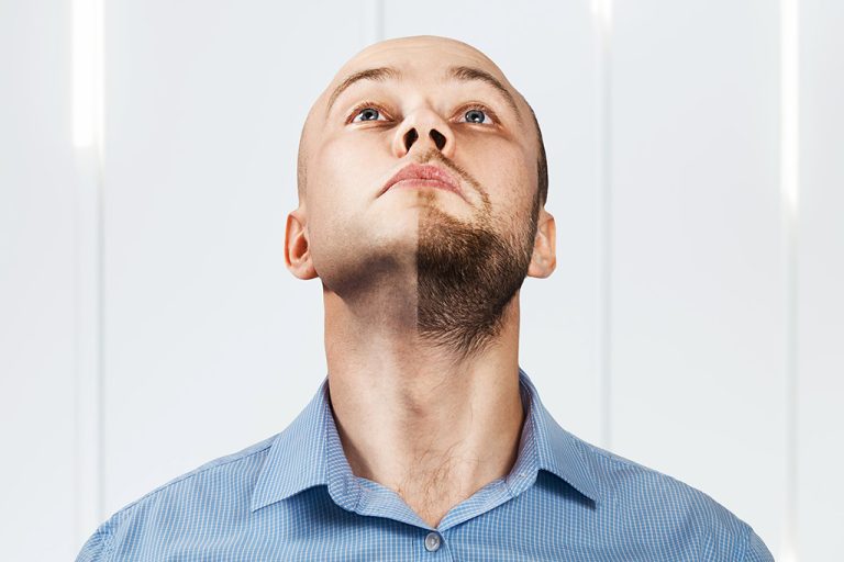 Facial Hair Transplant 2 1