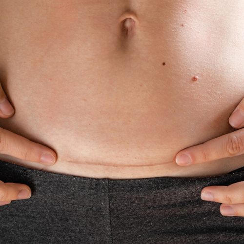 hysterectomy surgery