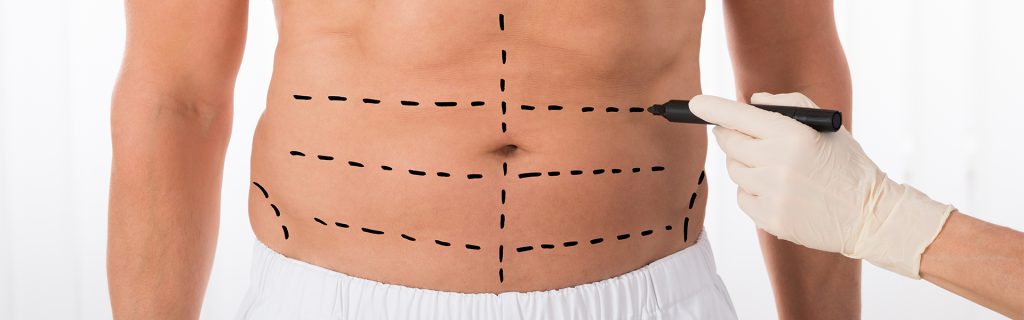 male tummy tuck surgery
