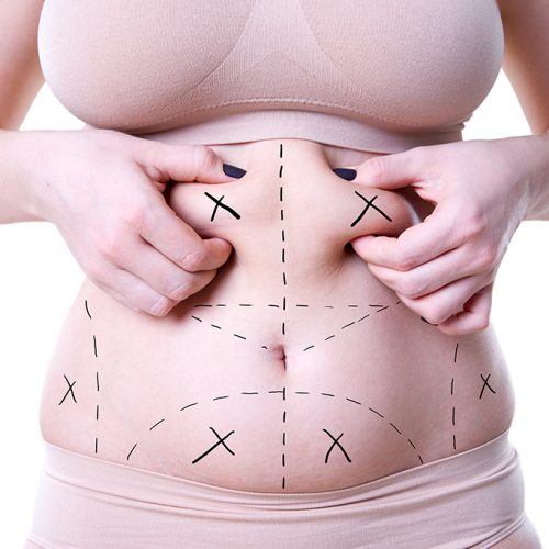 Reverse Tummy Tuck