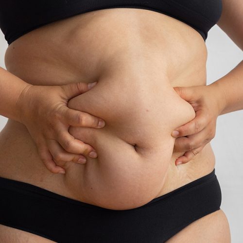 sleeve gastrectomy surgery