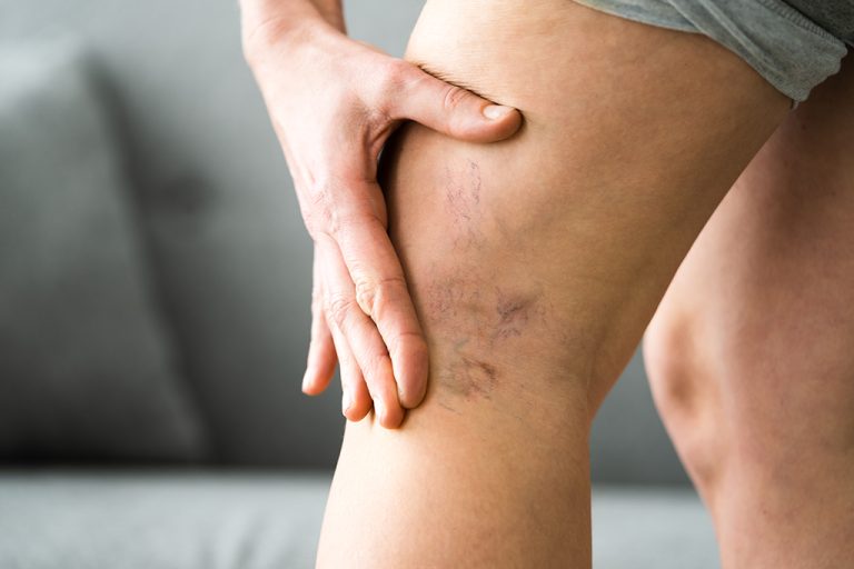 Spider Vein Removal Treatment