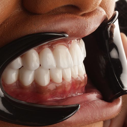 Zirconium Porcelain Crowns