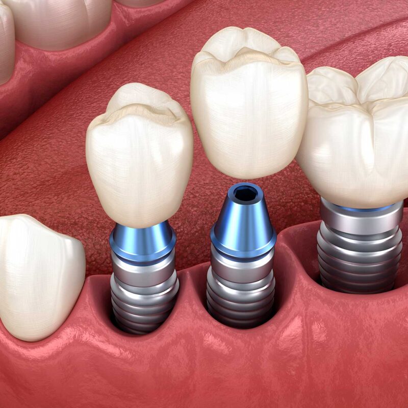 a model of teeth with implants