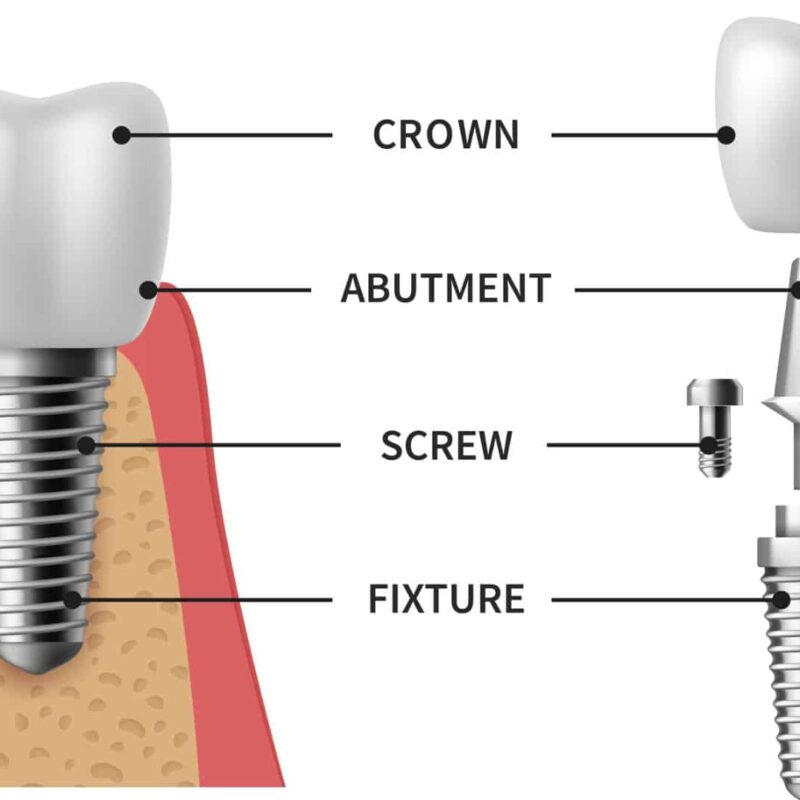 a diagram of a tooth with different types of screws