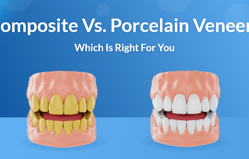 Composite Porcelain Veneers 1