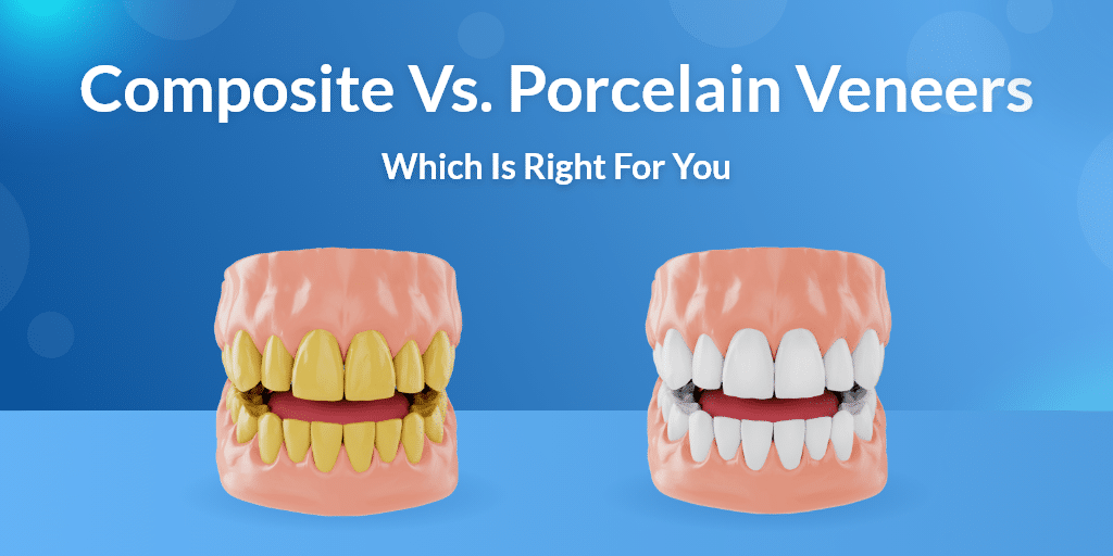 Composite Veneers: How Long Do They Last?