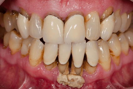 Gum Disease treatment turkey