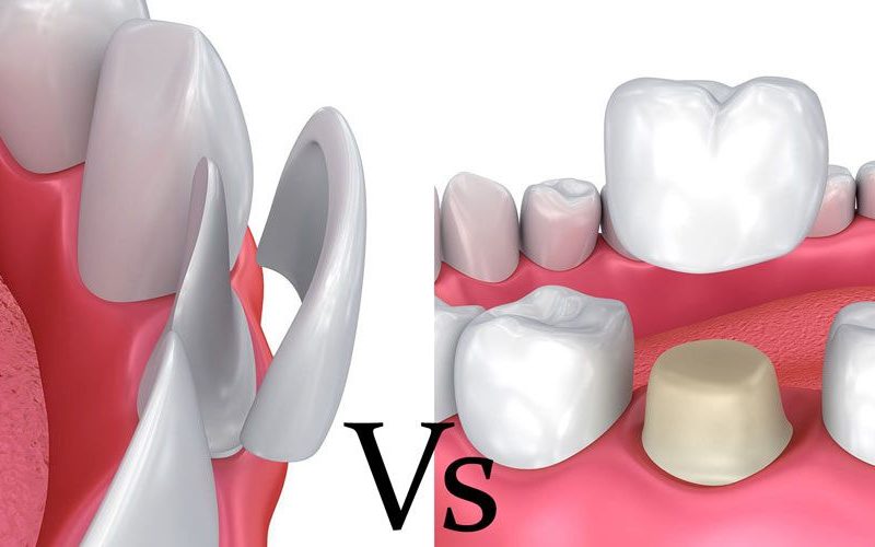 crowns vs veneers