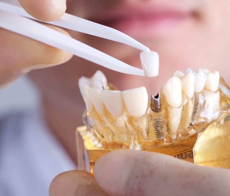 dental implants will change your life