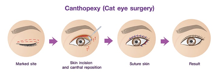 cat-eye-surgery