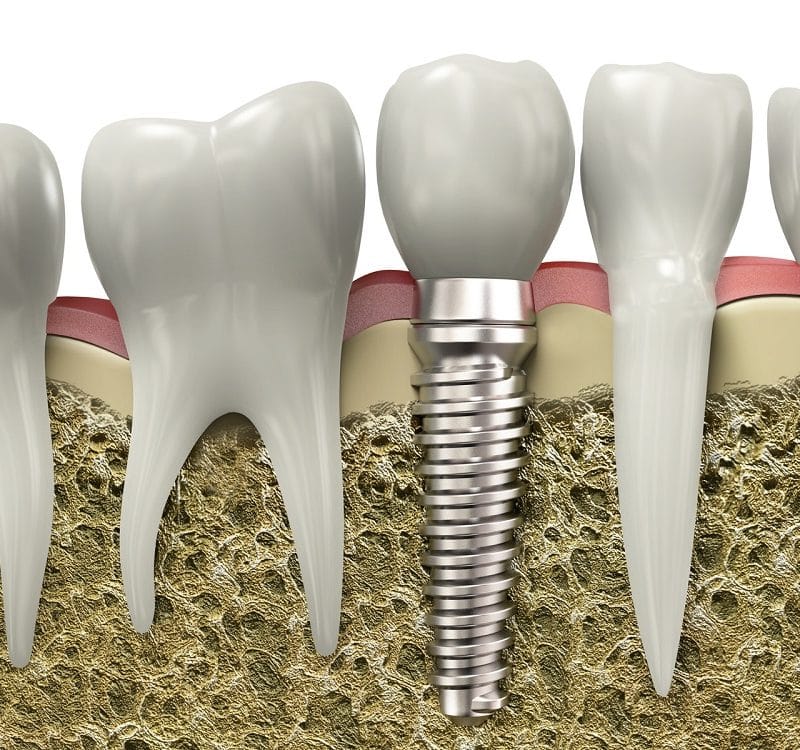 dental-implant-surgery-turkey