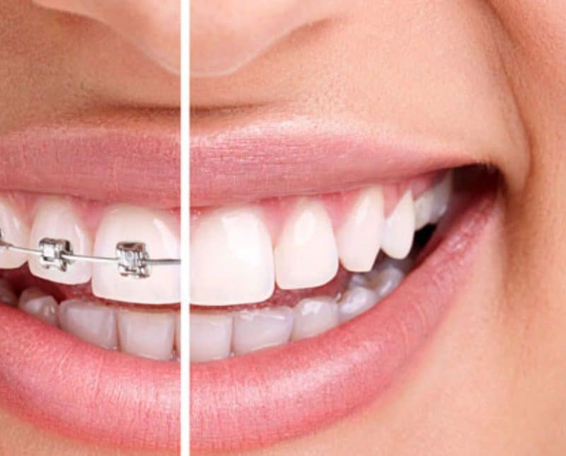 orthodontic-treatment