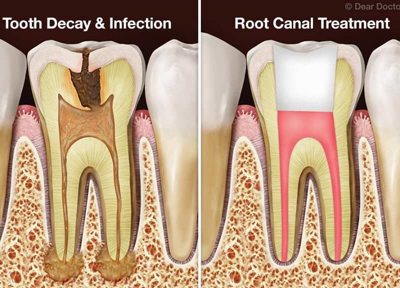 root-canal-treatment-turkey