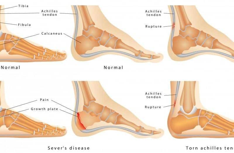 Achilles-Tendon-Injury-revitalizeinturkey