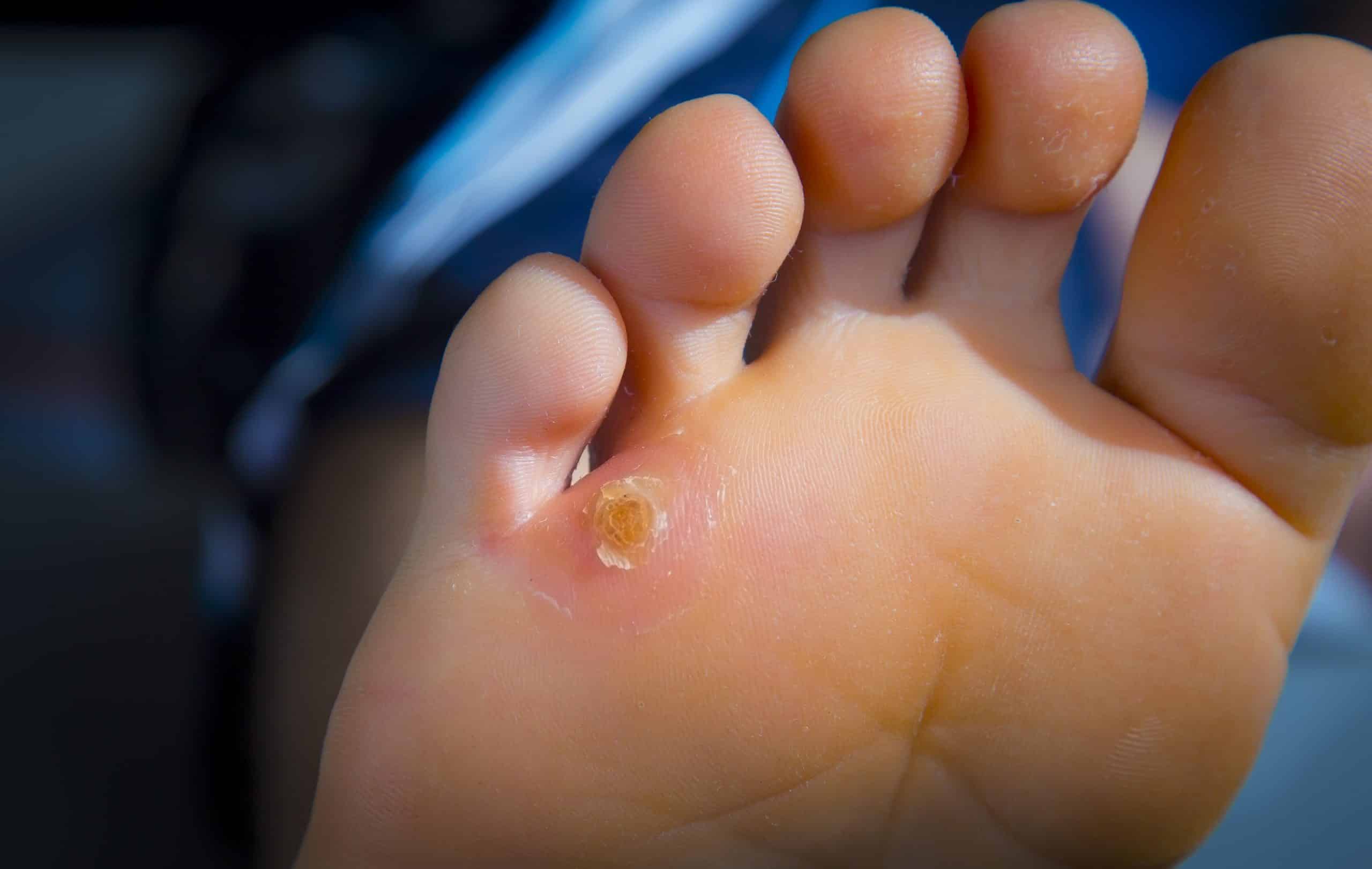 Callus on Foot: Causes, Treatment, and Prevention