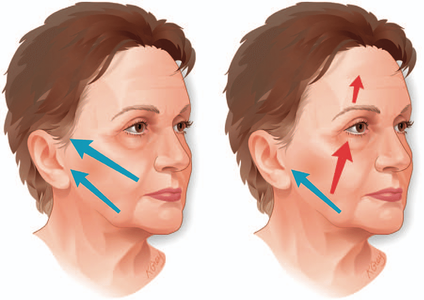 Deep Plane Facelift vs Traditional Facelift: Key Differences