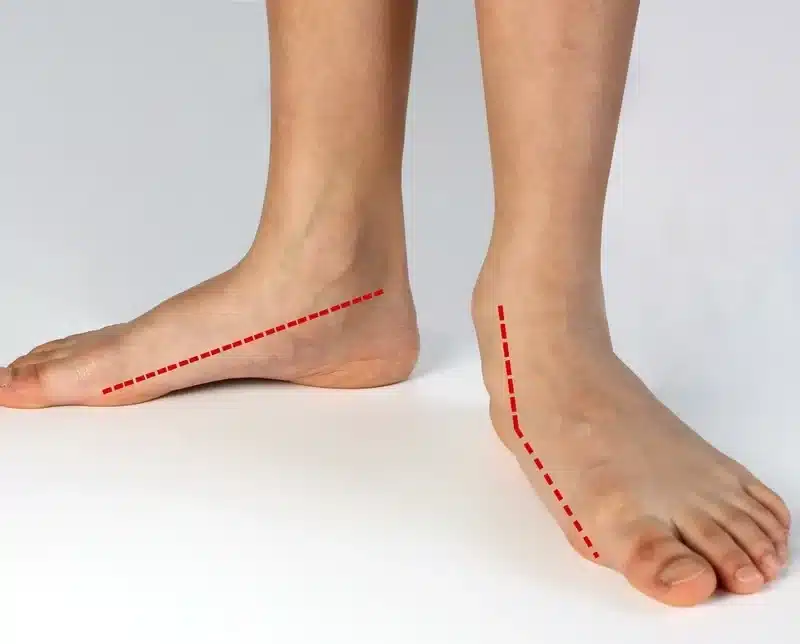 Flat feet-surgery-revitalizeinturkey