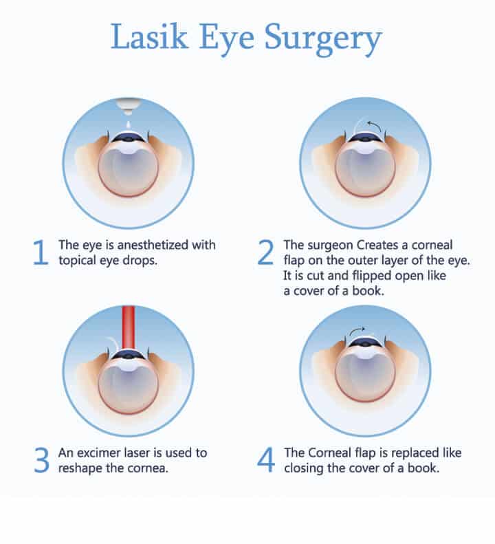 LASIK Eye Surgery: How It Works & What to Expect