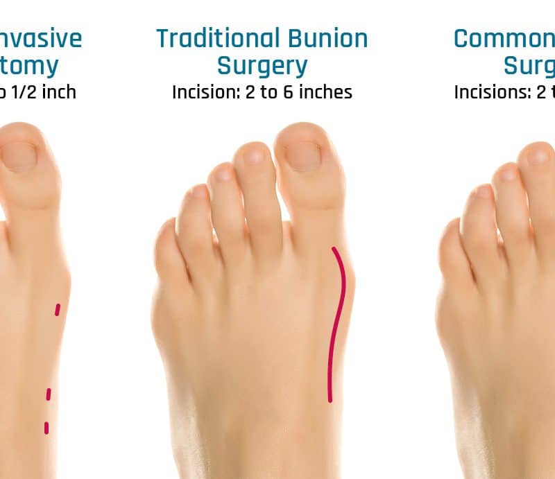 Minimally_Invasive-bunion-removal-revitalizeinturkey