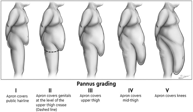 Understanding Apron Belly Grades: What to Know