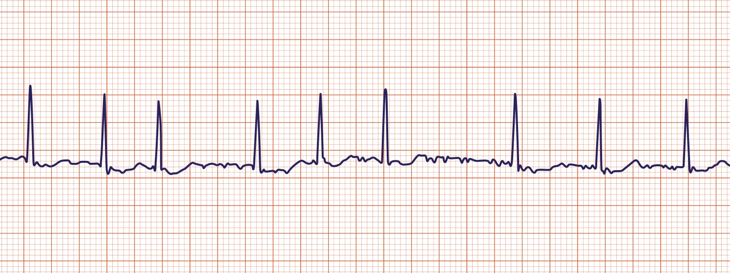 Understanding Atrial Fibrillation Risks & Care