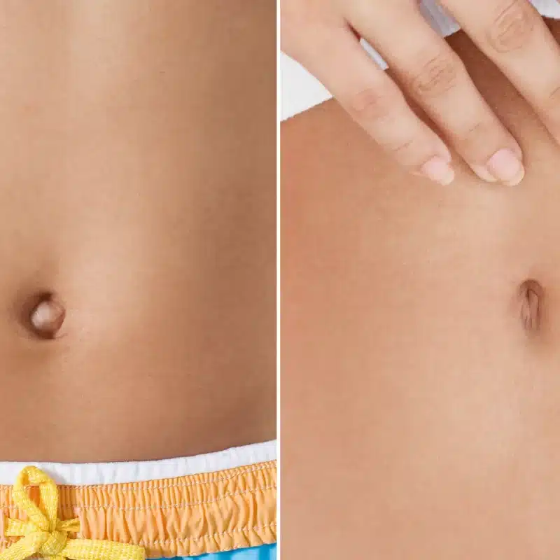 bellybutton-surgery-revitalizeinturkey