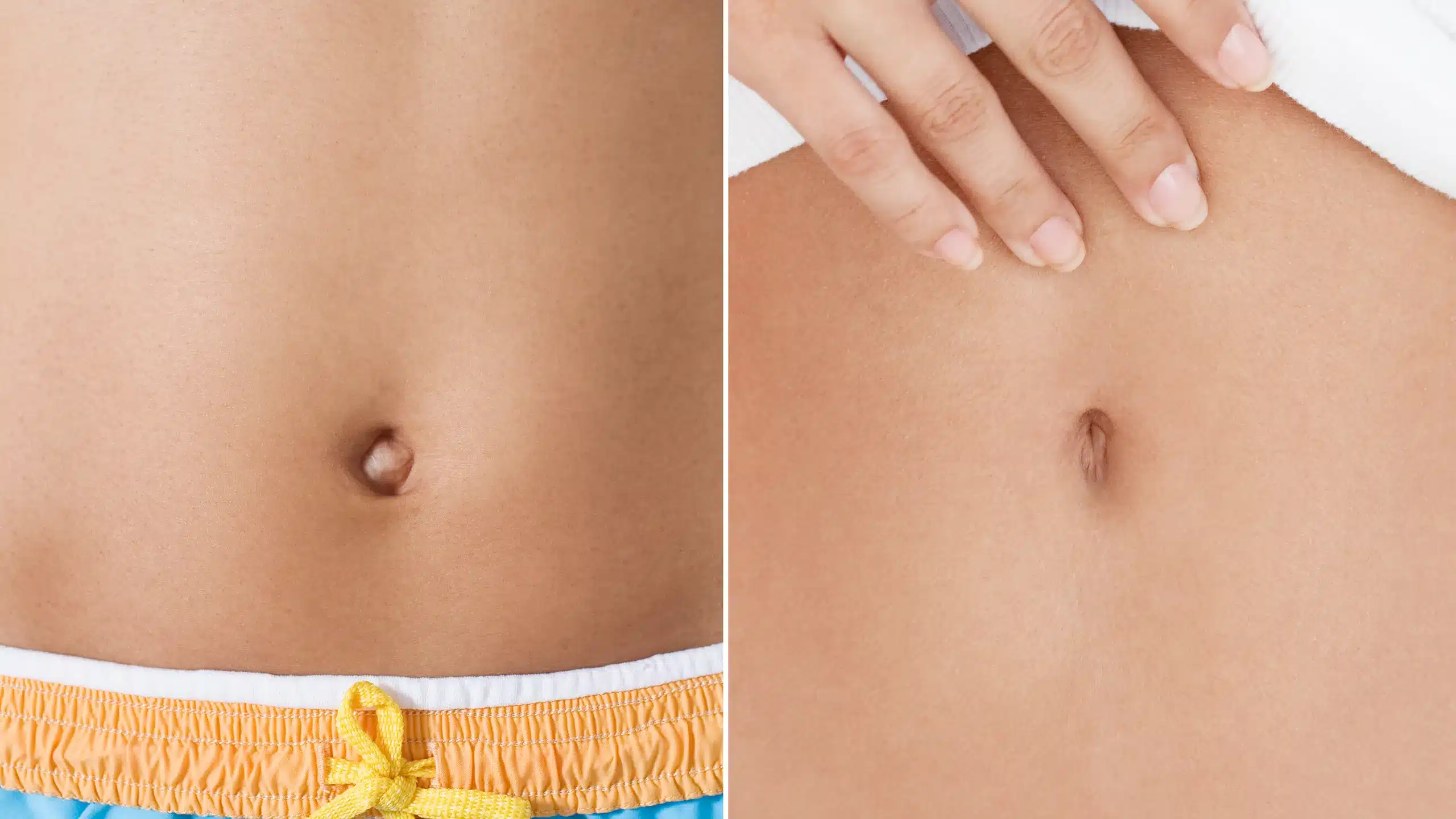 Belly Button Surgery: Transform Your Navel Today