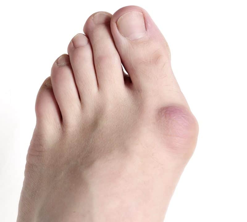 bunion_removal_surgery_revitalizeinturkey