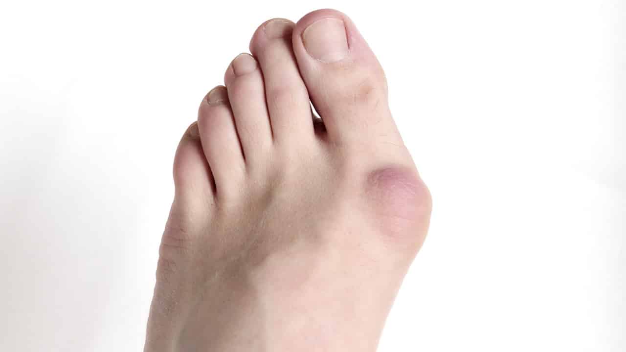 Bunion Surgery: Restore Comfort to Your Feet