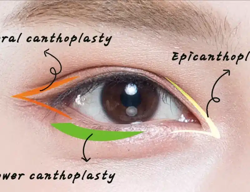 canthoplasty-surgery-revitalizeinturkey