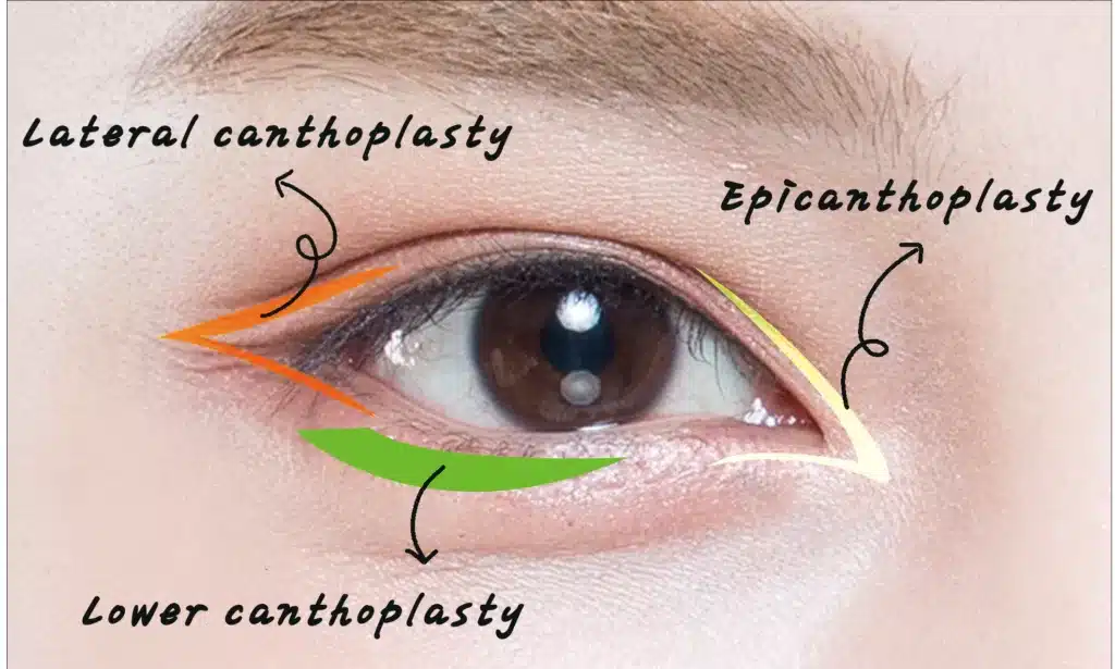 Canthoplasty: Enhance Your Eye Shape and Appearance