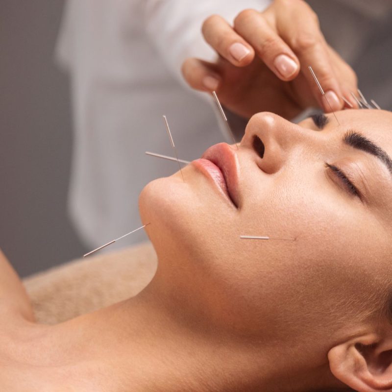 facial-acupuncture-revitalizeinturkey