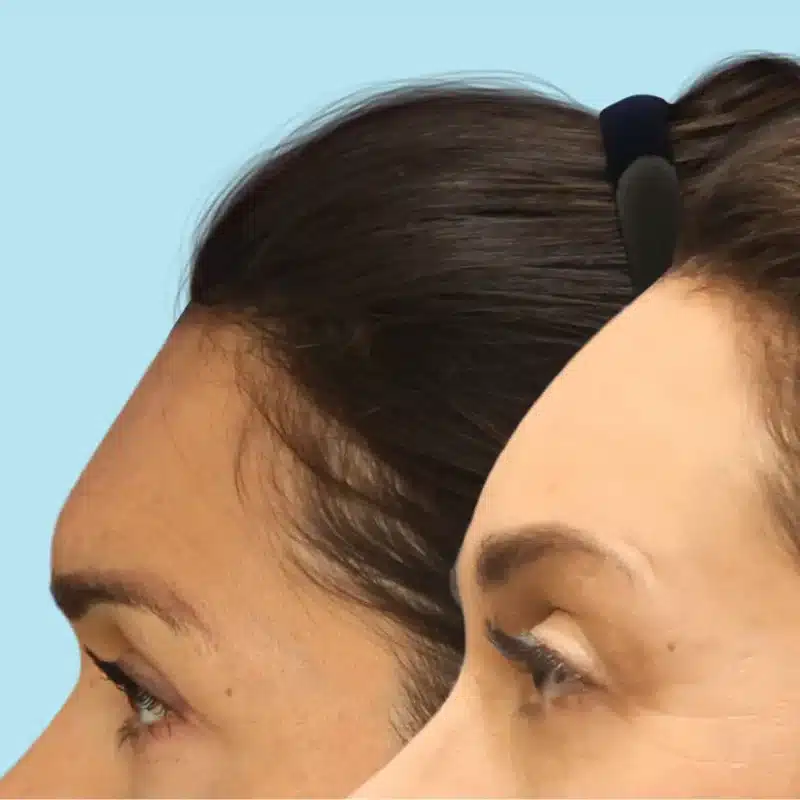 forehead_reduction_revitalizeinturkey