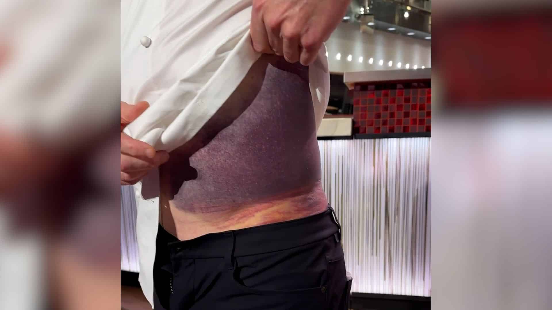 Gordon Ramsay Bruise: Facts Behind the Injury