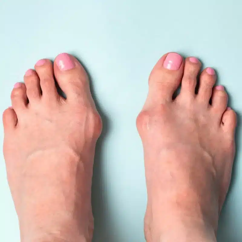 hallux-valgus-surgery-revitalizeinturkey