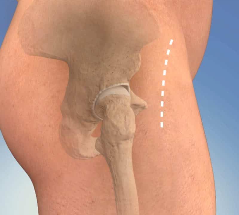 hip-implant-revitalizeinturkey