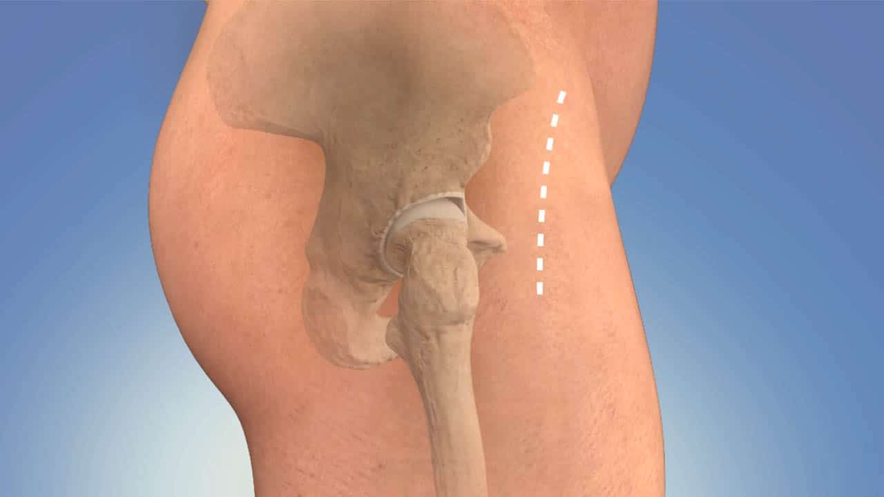 Hip Implants: Restoring Mobility and Quality of Life