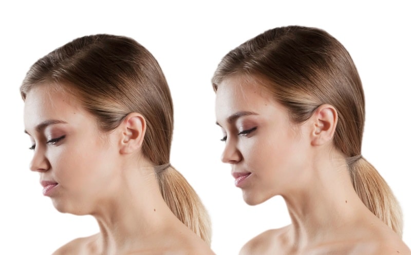 Jaw Surgery: Improving Function and Aesthetics