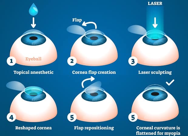 Laser Eye Surgery Cost: What You Need to Know