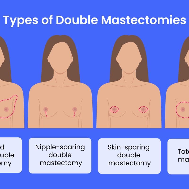 mastectomy-types