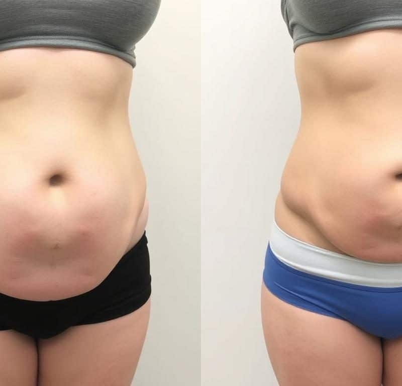 panniculectomy before and after weight loss