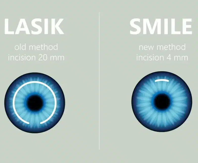 smile-eye-surgery