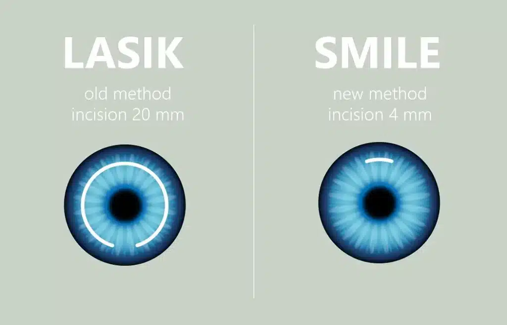 Smile Laser Eye Surgery: Clear Vision, Quick Recovery