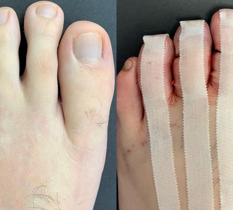 toe-shortening-surgery-revitalizeinturkey