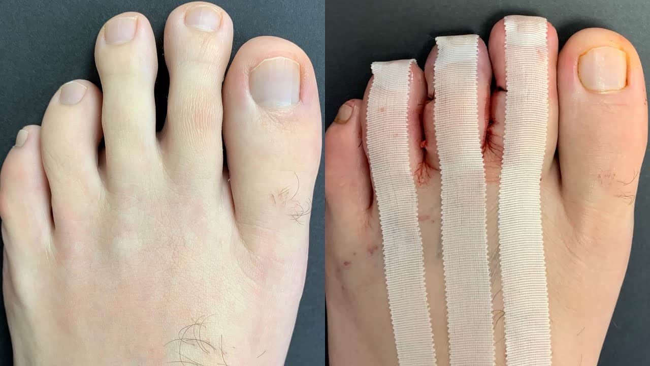 Toe Shortening Surgery: Improve Foot Comfort