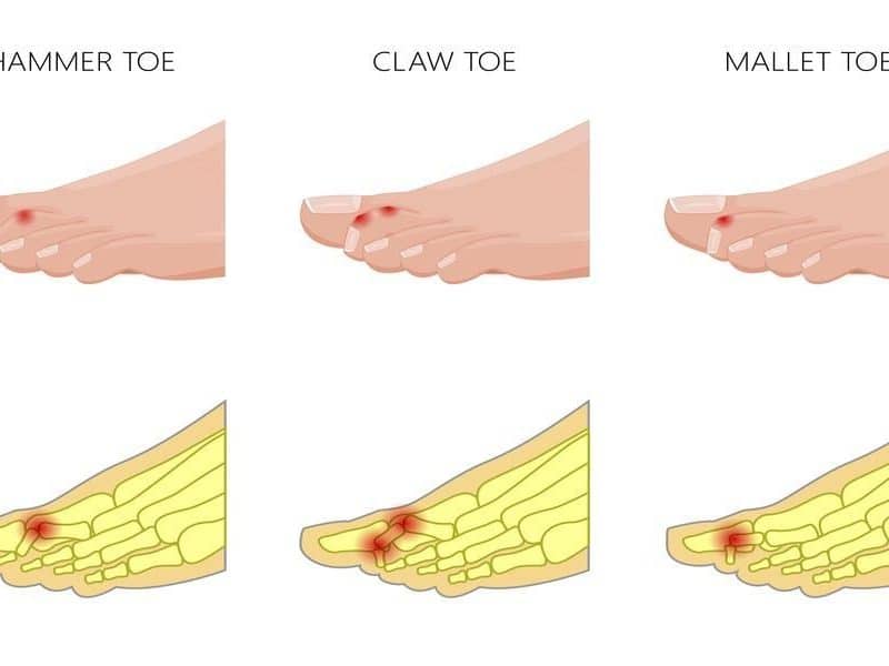 toe-straightening-surgery